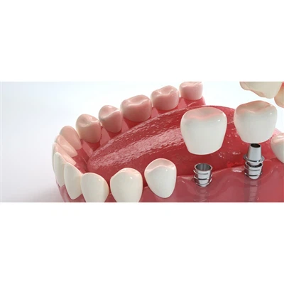 Abutment Dilemma: موزوں درستگی یا آف دی شیلف سادگی؟