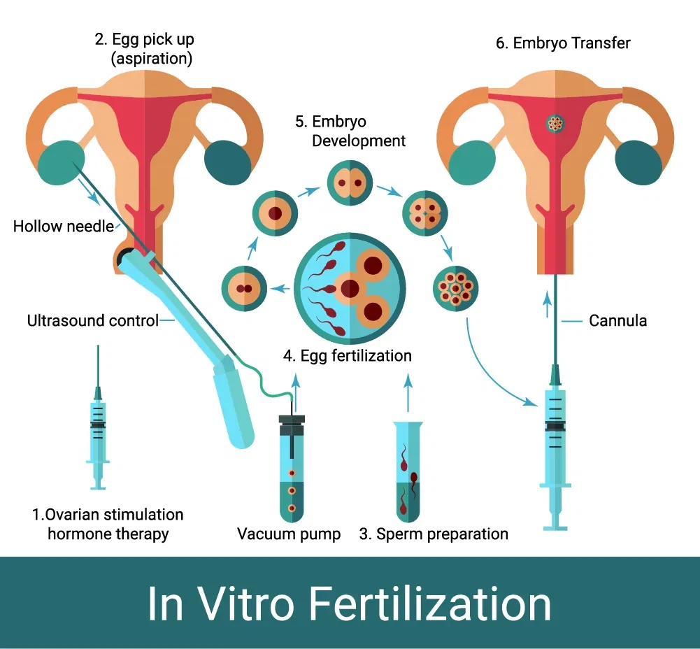 IVF کے طریقہ کار میں انڈے کی بازیافت سوئوں کے مختلف سائز کی تاثیر